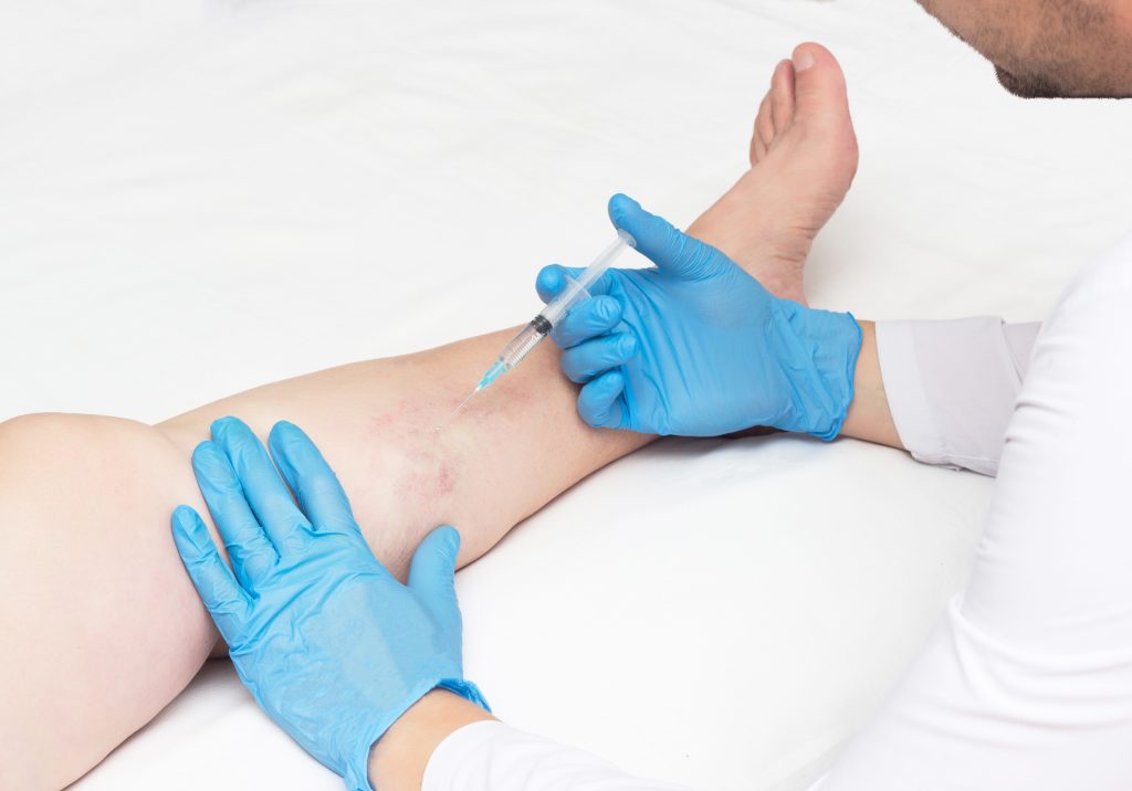 Vein Treatment: A Natural Approach